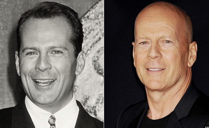 How They Looked: Famous Bald Celebs Before Going Bald